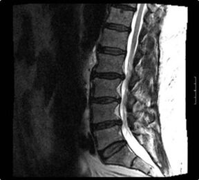 Kaklo stuburo rentgeno nuotrauka su osteochondroze
