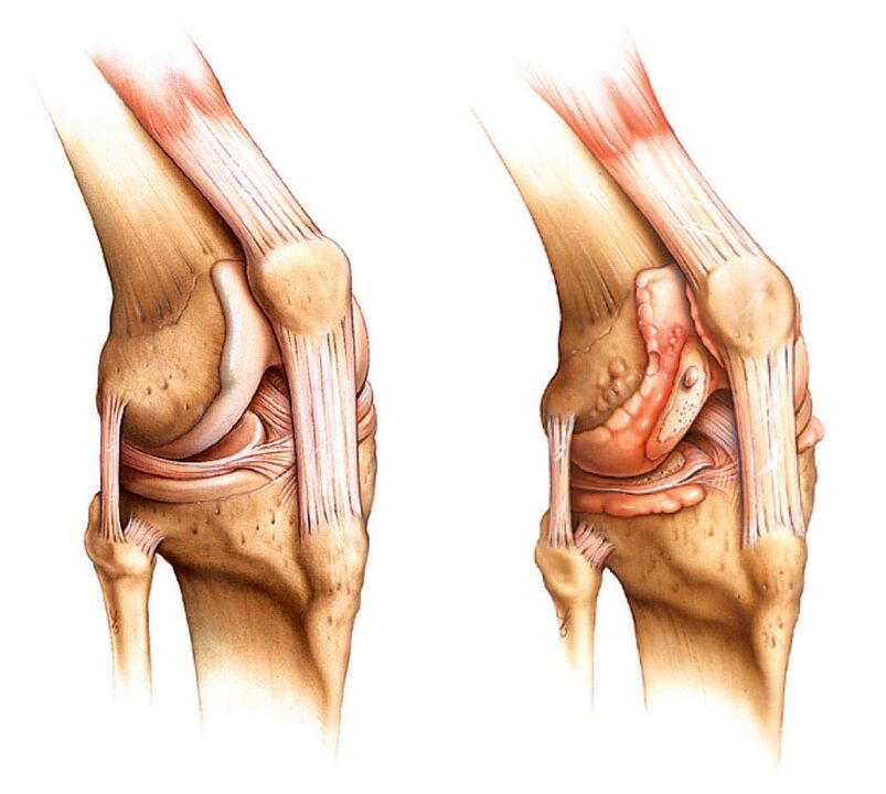 Sveikas sąnarys (kairėje) ir artritas (dešinėje)
