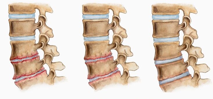 Tarpslankstelinių diskų deformacija sergant osteochondroze gali sukelti nugaros skausmą