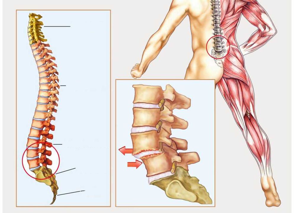 sveikas ir sergantis stuburas