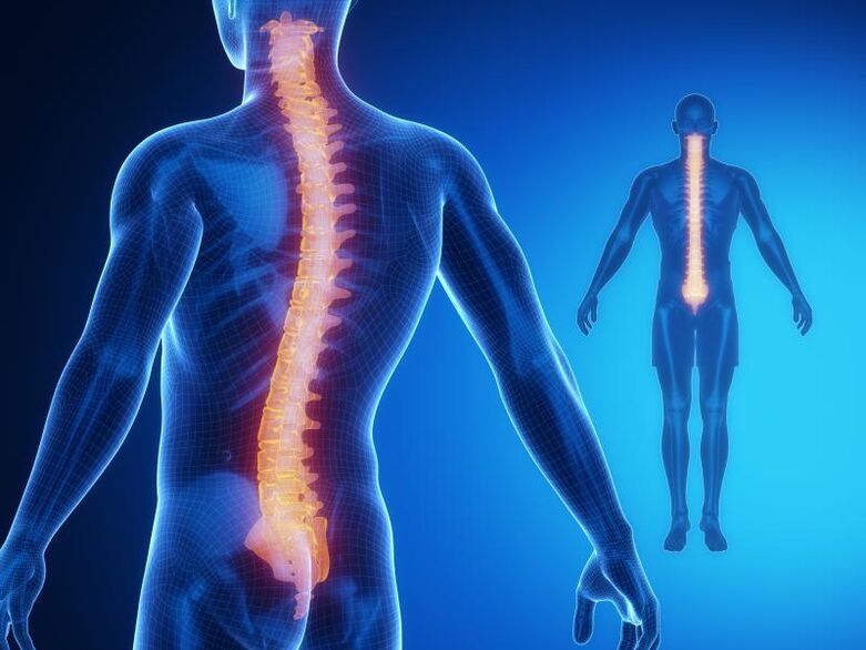 Stuburo osteochondrozė, reikalaujanti kompleksinio gydymo