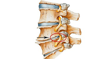 suspaustas stuburo diskas, kaip gimdos kaklelio osteochondrozės priežastis