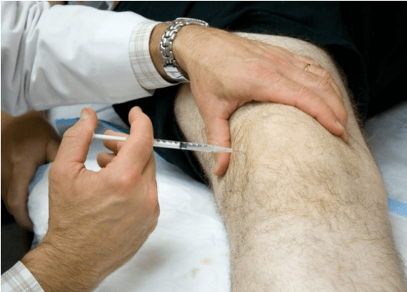 Intra -artikuliarinis analgetikų vartojimas esant stipriam skausmui